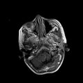 Cerebral abscess post cardiac surgery (Radiopaedia 27244-27420 Axial T1 C+ 1).jpg