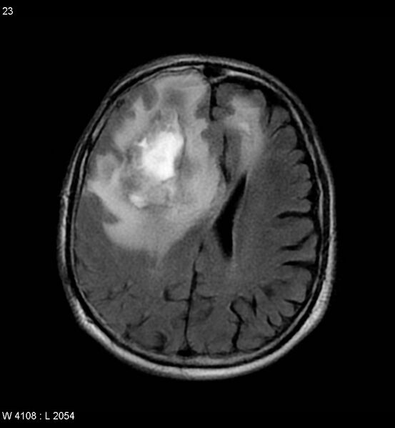 File:Cerebral abscesses secondary to contusions (Radiopaedia 5201-6968 Axial FLAIR 2).jpg