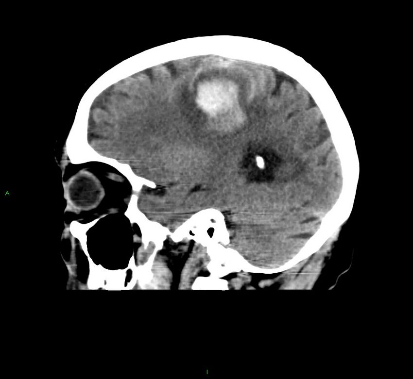 Cerebral amyloid angiopathy-associated lobar intracerebral hemorrhage (Radiopaedia 58376-65511 C 36).jpg