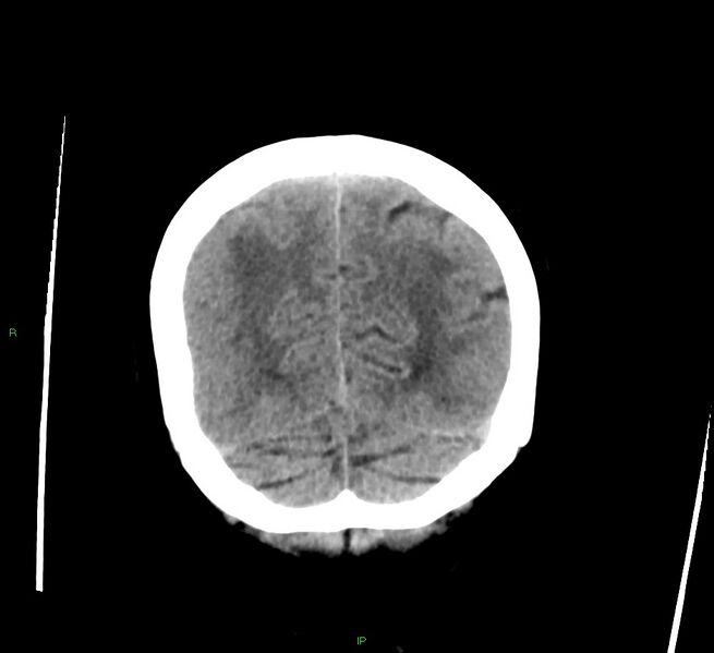 File:Cerebral amyloid angiopathy-associated lobar intracerebral hemorrhage (Radiopaedia 58378-65516 Coronal non-contrast 14).jpg