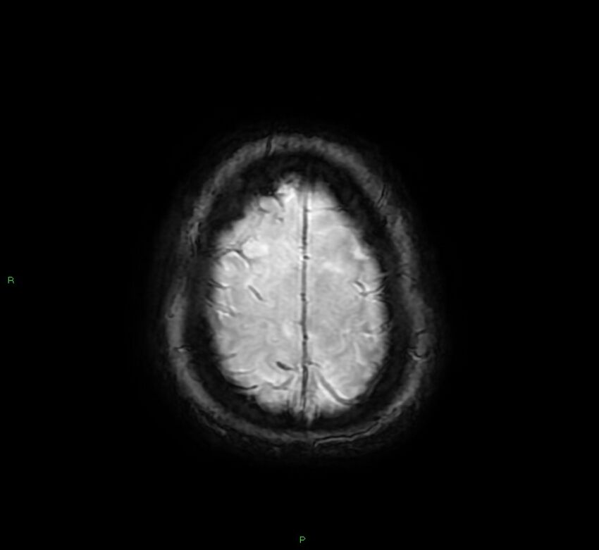 Cerebral amyloid angiopathy-associated lobar intracerebral hemorrhage (Radiopaedia 58378-65517 Axial SWI 65).jpg