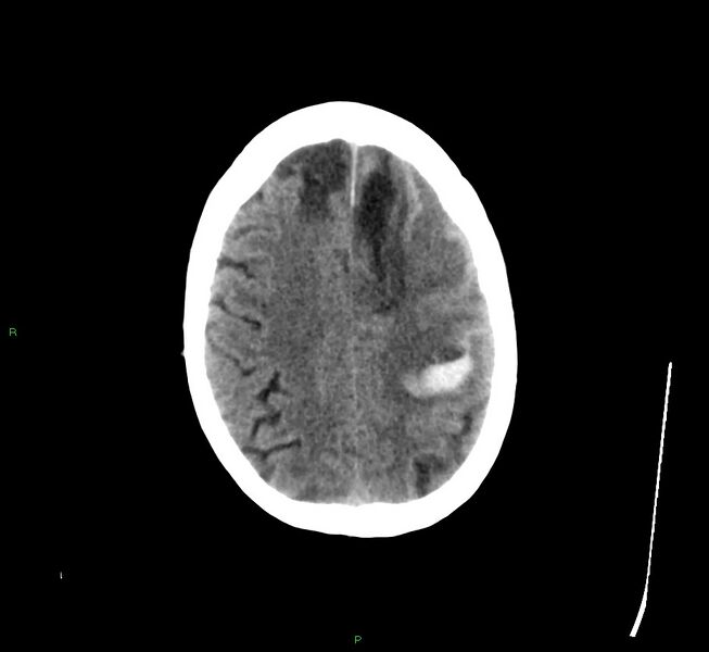 File:Cerebral amyloid angiopathy-associated lobar intracerebral hemorrhage (Radiopaedia 58529-65681 Axial non-contrast 14).jpg