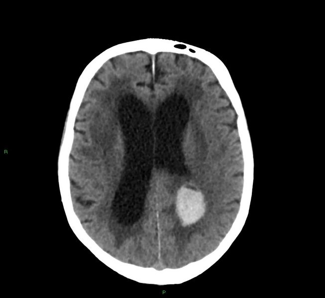 File:Cerebral amyloid angiopathy-associated lobar intracerebral hemorrhage (Radiopaedia 58530-65688 Axial non-contrast 20).jpg