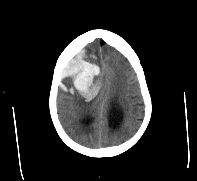 File:Cerebral amyloid angiopathy-associated lobar intracerebral hemorrhage (Radiopaedia 58560-65723 Axial non-contrast 16).jpg