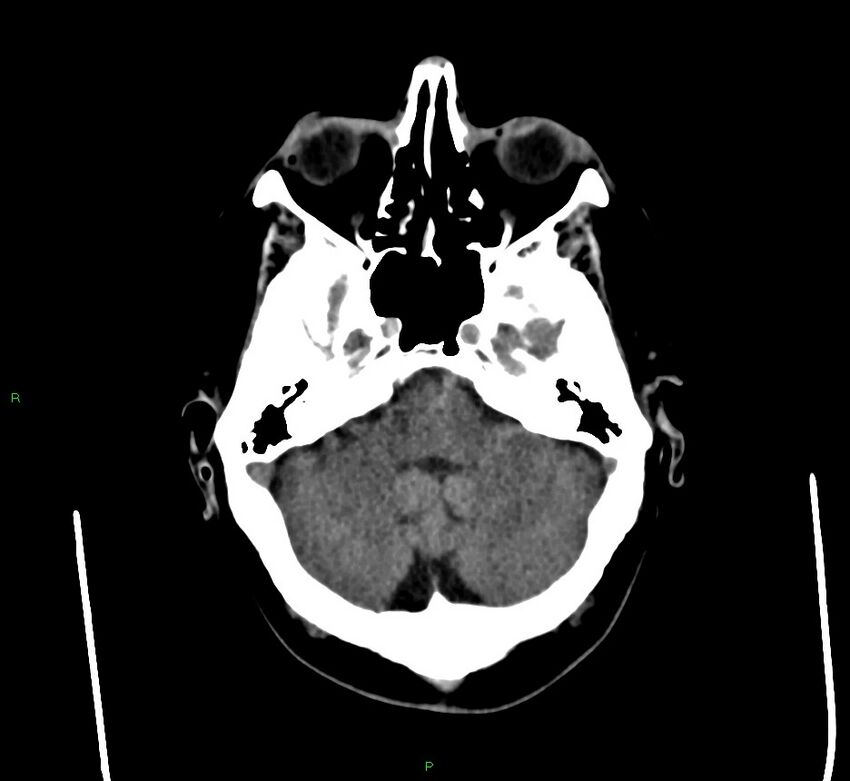 Cerebral amyloid angiopathy-associated lobar intracerebral hemorrhage (Radiopaedia 58560-65723 Axial non-contrast 41).jpg