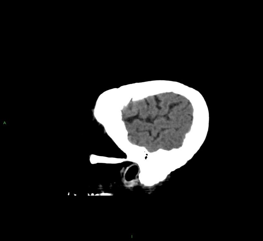 Cerebral amyloid angiopathy-associated lobar intracerebral hemorrhage (Radiopaedia 58560-65723 C 46).jpg