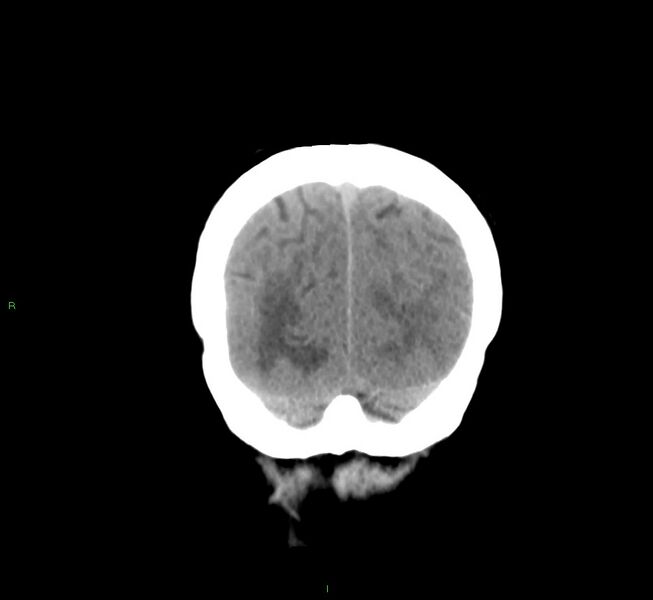 File:Cerebral amyloid angiopathy-associated lobar intracerebral hemorrhage (Radiopaedia 58561-65724 Coronal non-contrast 12).jpg