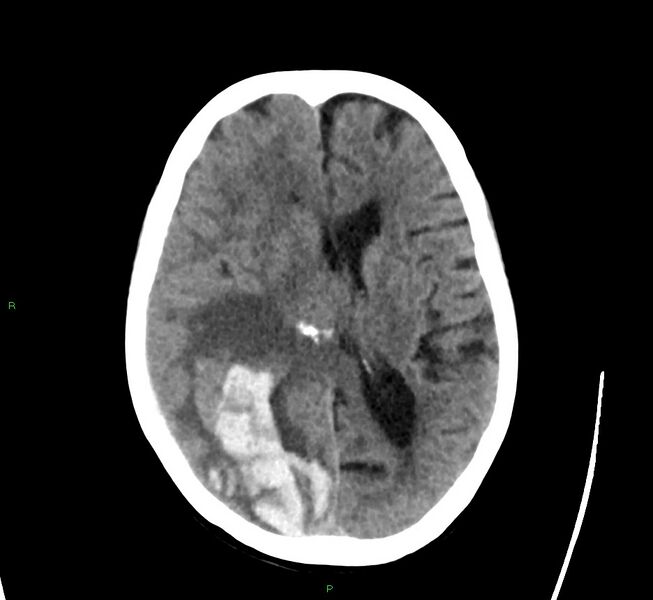 File:Cerebral amyloid angiopathy-associated lobar intracerebral hemorrhage (Radiopaedia 58563-65727 Axial non-contrast 26).jpg