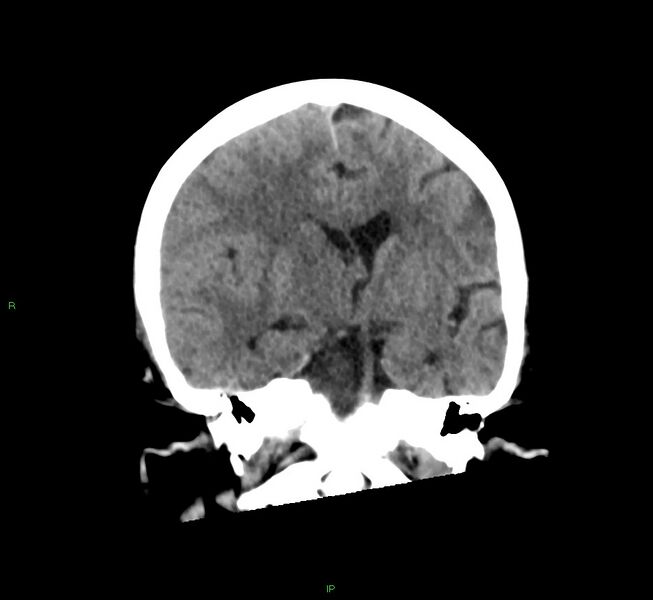 File:Cerebral amyloid angiopathy-associated lobar intracerebral hemorrhage (Radiopaedia 58563-65727 Coronal non-contrast 37).jpg