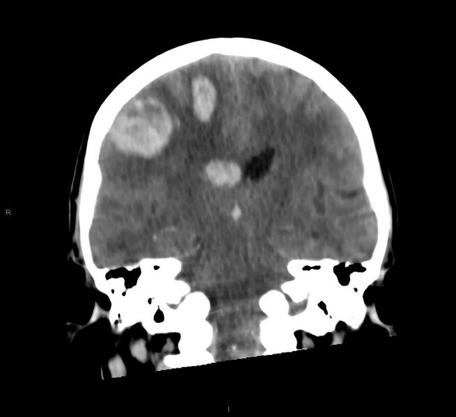 File:Cerebral amyloid angiopathy-associated lobar intracerebral hemorrhage (Radiopaedia 58566-65730 Coronal non-contrast 35).jpg