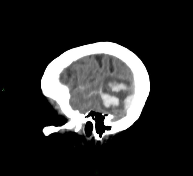 File:Cerebral amyloid angiopathy-associated lobar intracerebral hemorrhage (Radiopaedia 58757-65978 C 46).jpg