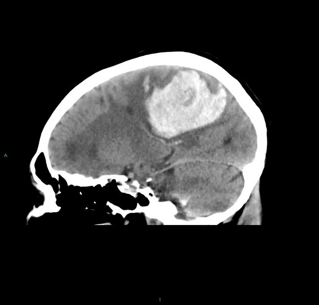 File:Cerebral amyloid angiopathy-associated lobar intracerebral hemorrhage (Radiopaedia 59356-66716 C 23).jpg