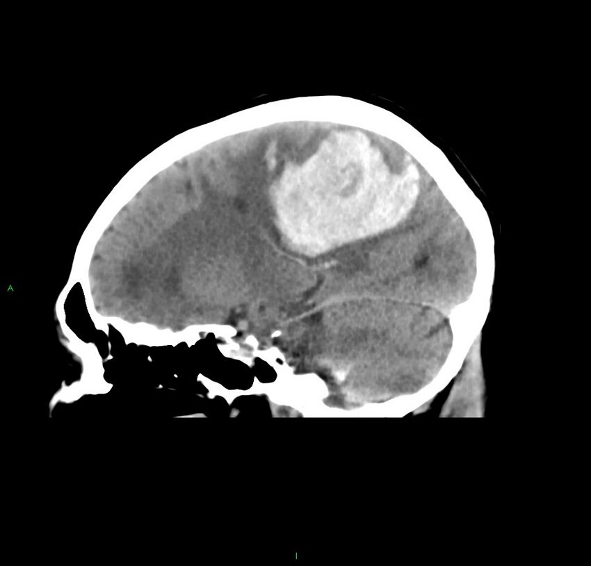 Cerebral amyloid angiopathy-associated lobar intracerebral hemorrhage (Radiopaedia 59356-66716 C 23).jpg