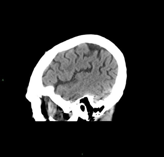 File:Cerebral amyloid angiopathy-associated lobar intracerebral hemorrhage (Radiopaedia 59356-66716 C 44).jpg
