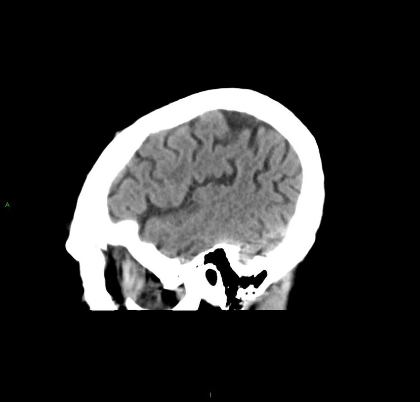Cerebral amyloid angiopathy-associated lobar intracerebral hemorrhage (Radiopaedia 59356-66716 C 44).jpg
