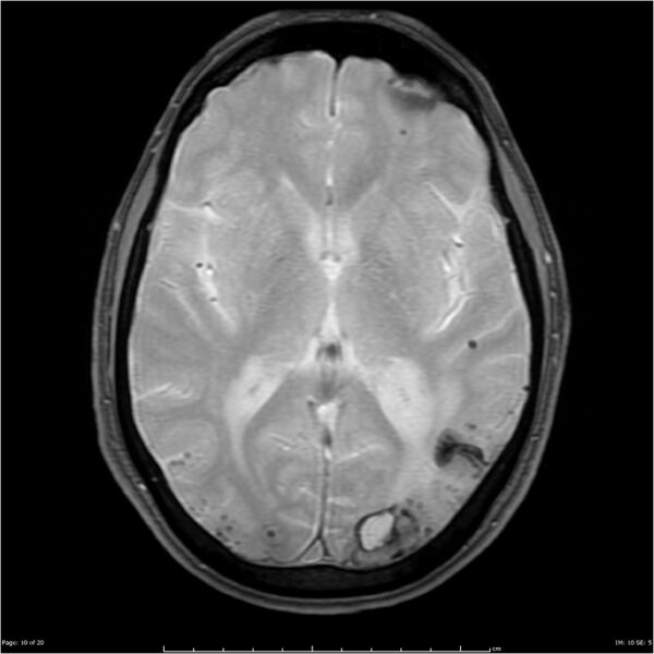 File:Cerebral amyloid angiopathy (Radiopaedia 4561-6683 Axial Gradient Echo 4).jpg