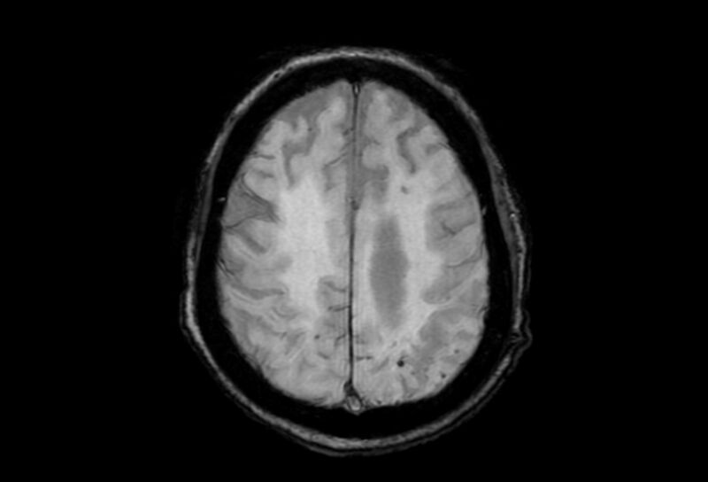 File:Cerebral amyloid angiopathy (Radiopaedia 86671-102792 Axial Gradient Echo 14).jpg