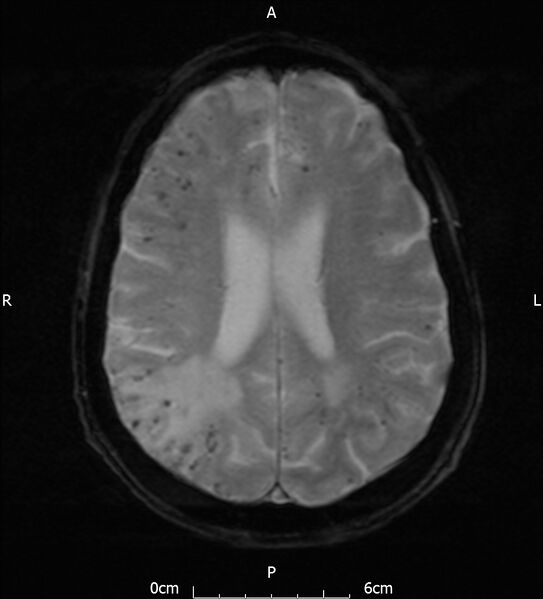 File:Cerebral amyloid angiopathy related inflammation (Radiopaedia 72772-83415 Axial SWI 15).jpg