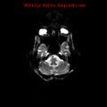 Cerebral and orbital tuberculomas (Radiopaedia 13308-13311 Axial DWI 24).jpg