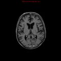Cerebral and orbital tuberculomas (Radiopaedia 13308-13311 Axial T1 C+ 12).jpg