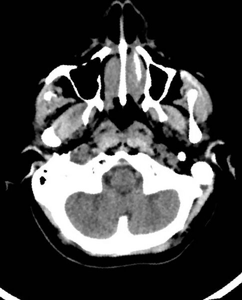 File:Cerebral edema due to severe hyponatremia (Radiopaedia 89826-106938 Axial non-contrast 15).jpg
