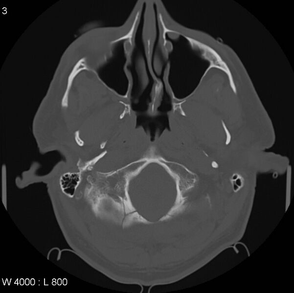 File:Cerebral hemorrhagic contusion with subdural and subarachnoid hemorrhage (Radiopaedia 10680-11146 Axial bone window 3).jpg