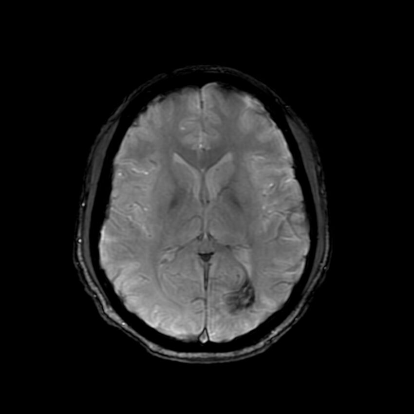 Cerebral paragonimiasis (Radiopaedia 73473-84238 Axial SWI 38).jpg