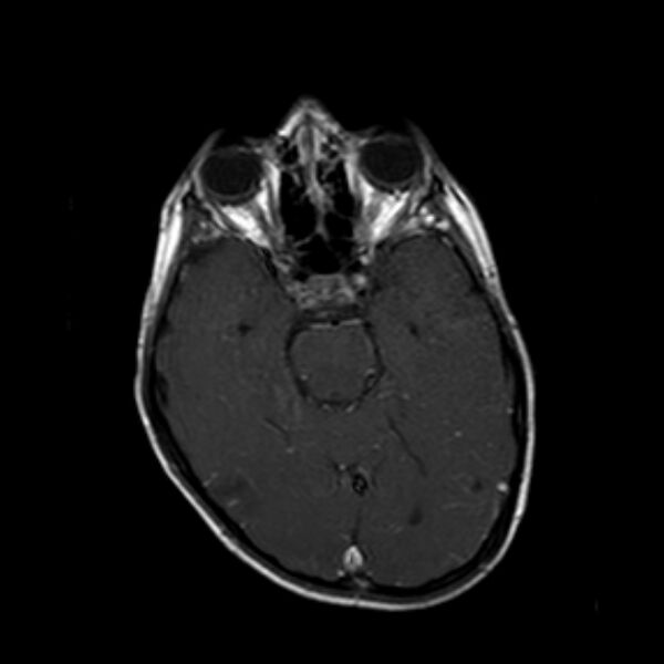 File:Cerebral tuberculoma (Radiopaedia 41152-43932 Axial T1 C+ 8).jpg
