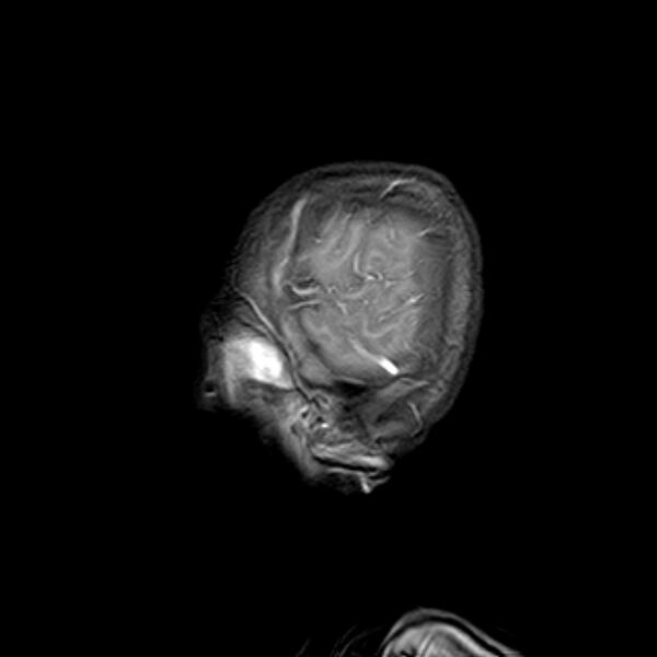 File:Cerebral tuberculoma (Radiopaedia 41152-43932 Sagittal T1 C+ 18).jpg