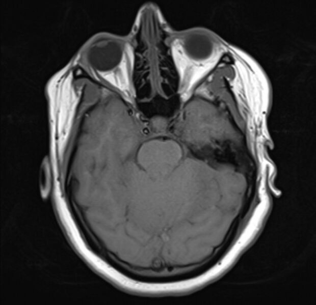 File:Cerebral venous infarct (Radiopaedia 53627-59685 Axial T1 9).jpg
