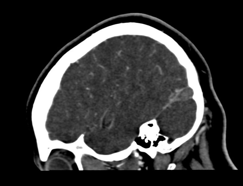File:Cerebral venous sinus thrombosis (Radiopaedia 59224-66646 Sagittal C+ delayed 54).jpg