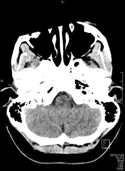 File:Cerebral venous sinus thrombosis (Radiopaedia 91329-108965 Axial non-contrast 9).jpg