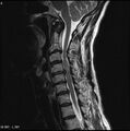 Cervical disc extrusion (Radiopaedia 5216-6982 Sagittal T2 3).jpg