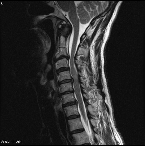 File:Cervical disc extrusion (Radiopaedia 5216-6982 Sagittal T2 3).jpg