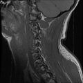 Cervical flexion teardrop fracture with cord hemorrhage (Radiopaedia 32497-33455 Sagittal T1 3).jpg