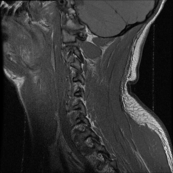 File:Cervical flexion teardrop fracture with cord hemorrhage (Radiopaedia 32497-33455 Sagittal T1 3).jpg