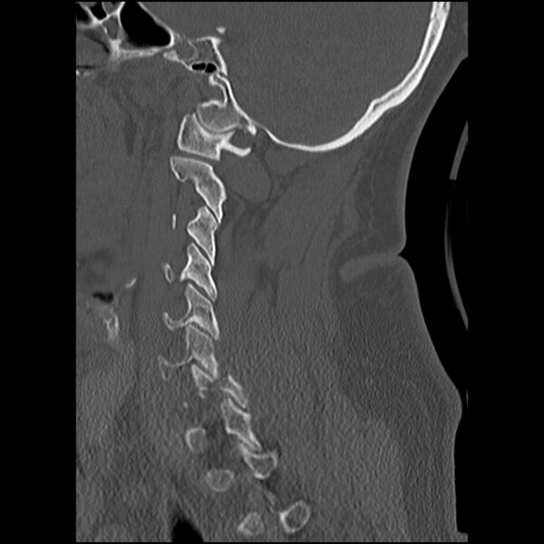 File:Cervical fracture and dislocation with locked facet (Radiopaedia 31837-32780 Sagittal bone window 7).jpg