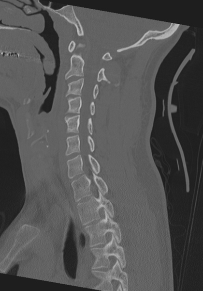 File:Cervical intercalary bone (Radiopaedia 35211-36748 Sagittal bone window 46).png