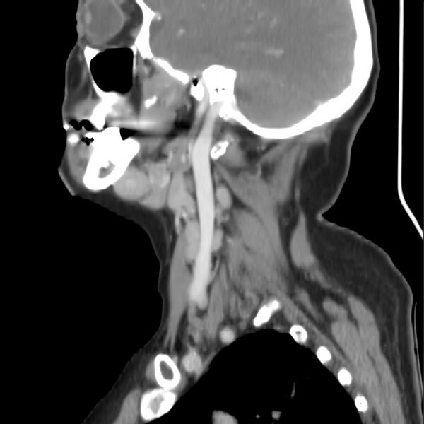 File:Cervical lymphadenopathy- cause unknown (Radiopaedia 22420-22457 D 11).jpg