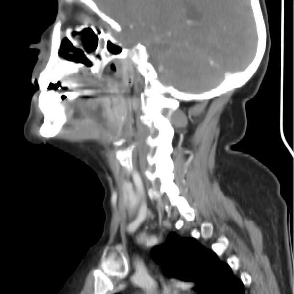 File:Cervical lymphadenopathy- cause unknown (Radiopaedia 22420-22457 D 15).jpg