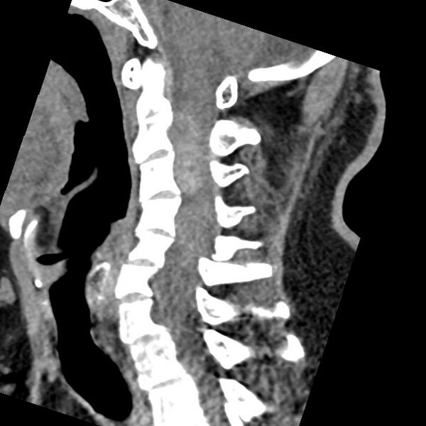 File:Cervical spinal neurofibroma in a patient with NF1 (Radiopaedia 58344-65464 C 29).jpg