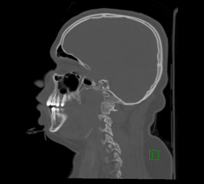 File:Cervical spine fracture - hyperflexion injury (Radiopaedia 66184-75364 A 7).jpg