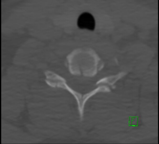 File:Cervical spine fracture - hyperflexion injury (Radiopaedia 66184-75364 Axial bone window 42).jpg