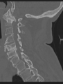 Cervical spondylolysis (Radiopaedia 49616-54811 Sagittal bone window 32).png