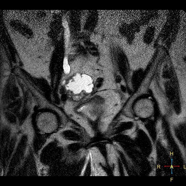 File:Cervical stump squamous cell carcinoma (Radiopaedia 48049-52858 Coronal T2 4).jpg