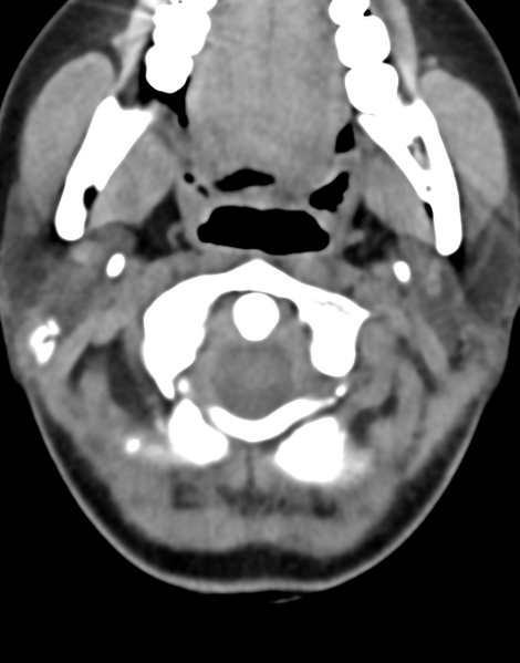File:Cervical tuberculous spondylitis (Radiopaedia 39149-41365 Axial non-contrast 9).png