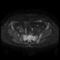 Cesarian section scar endometriosis (Radiopaedia 66520-75799 Axial DWI 55).jpg