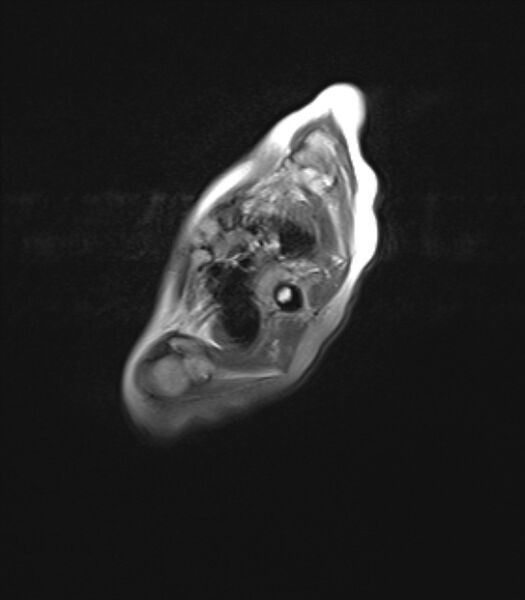 File:Chiari III malformation with occipital encephalocele (Radiopaedia 79446-92559 Axial FLAIR 1).jpg