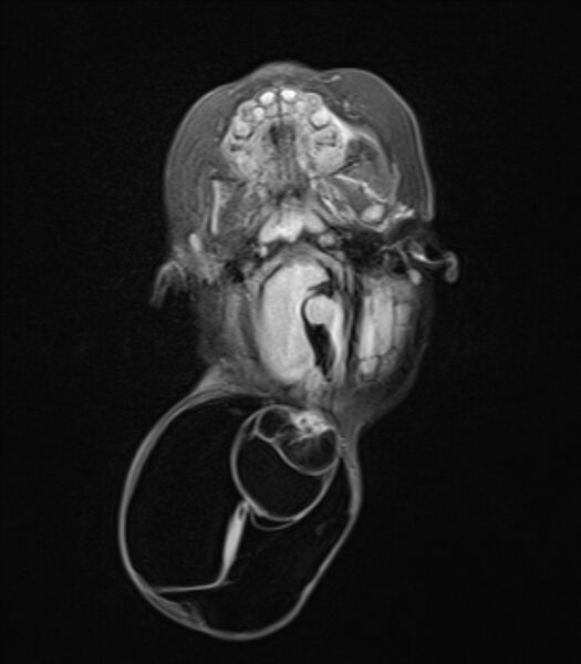 File:Chiari III malformation with occipital encephalocele (Radiopaedia 79446-92559 Axial FLAIR 10).jpg