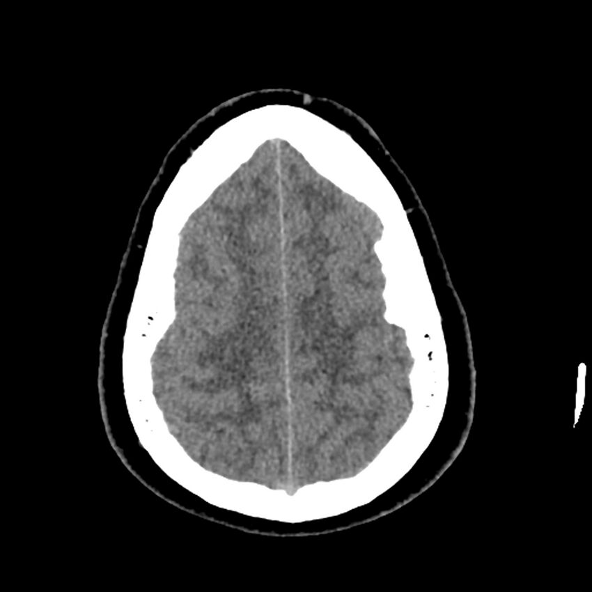 Chiasmatic-hypothalamic juvenile pilocytic astrocytoma (Radiopaedia 78533-91237 Axial non-contrast 47).jpg